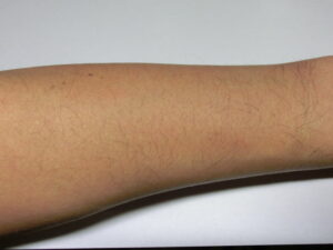 右腕（除毛前）