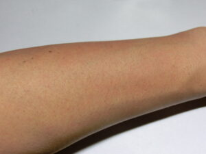 右腕（除毛後）