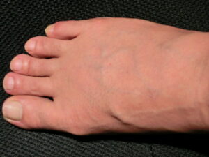 右足（除毛　処理後）