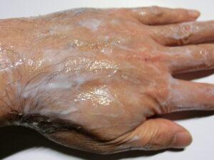 左手（除毛中）