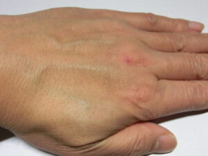 左手（除毛後）