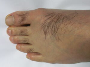 左足（除毛　処理前）