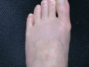 左足（除毛の処理前）