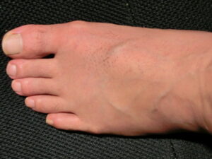 左足（除毛　処理後）