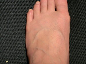 左足（除毛の処理後）