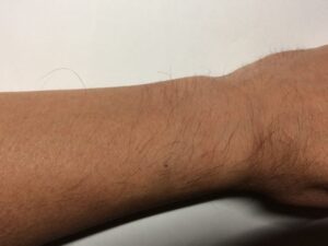 手の指の毛、手の甲の毛、腕の毛