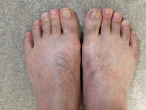 足の指・甲のムダ毛