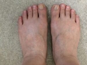 MONOVOヘアリムーバークリームで足の指・甲のムダ毛を除毛