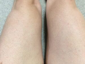 MONOVOヘアリムーバークリームで太もものムダ毛を除毛