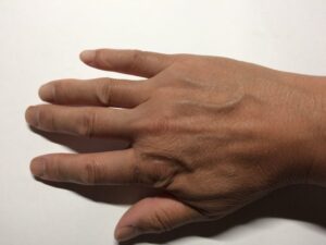 手の指の毛・甲の毛