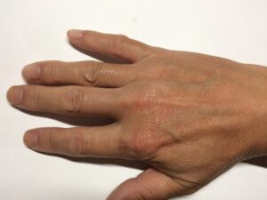 「MONOVOヘアリムーバークリーム」処理後