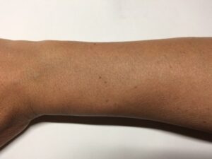 「MONOVOヘアリムーバークリーム」処理後