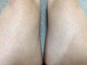 「MONOVOヘアリムーバークリーム」で太もものムダ毛処理後