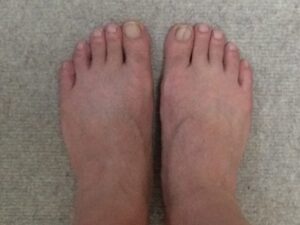 「MONOVOヘアリムーバークリーム」処理後