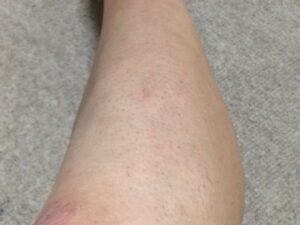 「MONOVOヘアリムーバークリーム」処理後