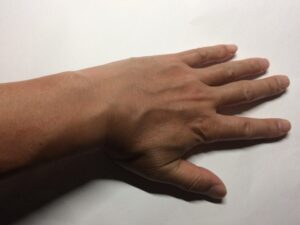 「NULLリムーバークリーム」ムダ毛処理後